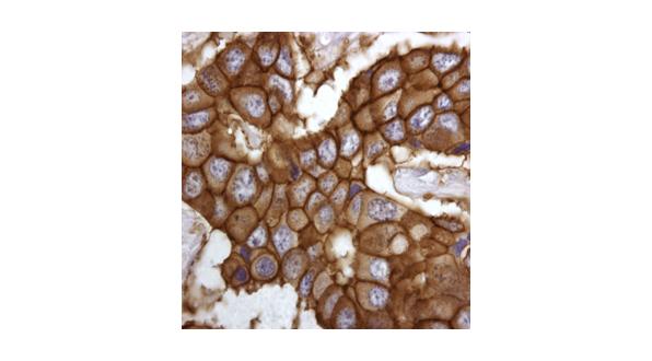 Figure 2 Staining breast cancer tissue
